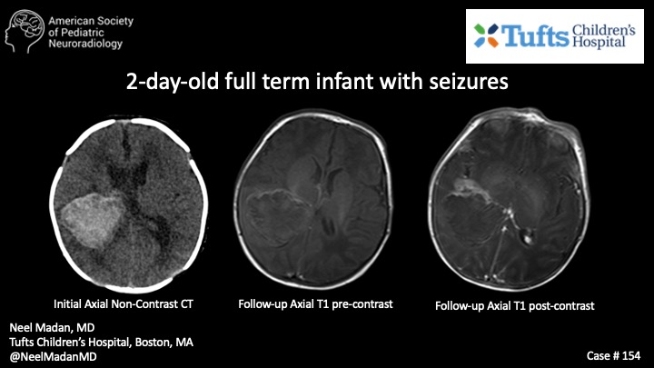 2-day-old full term infant with seizures | American Society of ...