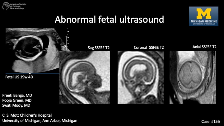 abnormal-fetal-ultrasound-american-society-of-pediatric-neuroradiology