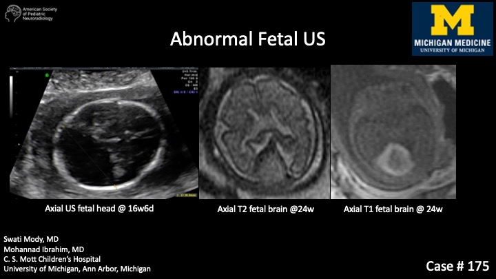 Abnormal Fetal US | American Society of Pediatric Neuroradiology