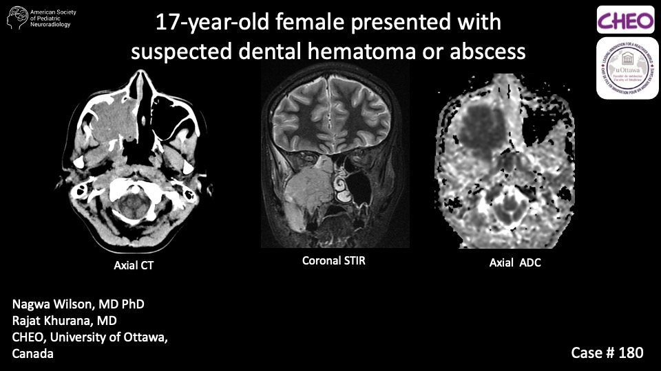 17-year-old female presented with suspected dental hematoma or abscess ...