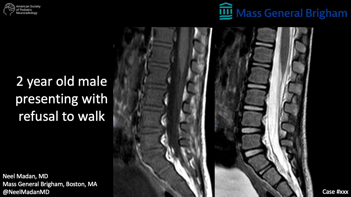 2 year old male presenting with refusal to walk | American Society of  Pediatric Neuroradiology