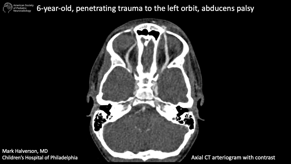 6-year-old, penetrating trauma to the left orbit, abducens palsy ...