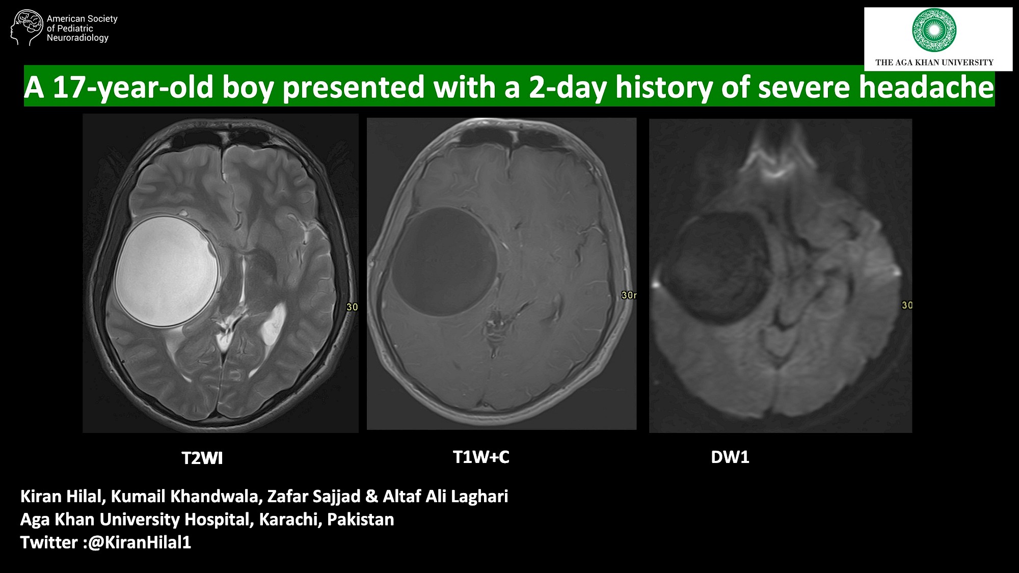 A 17-year-old boy presented with a 2-day history of severe headache ...